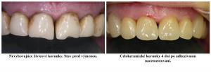 Celokeramické korunky.