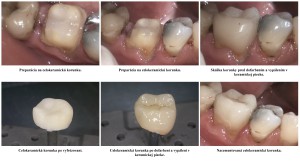 Cerec rekonštrukcia